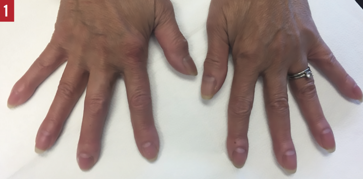 Digital Clubbing An Easily Overlooked Sign Associated With Systemic